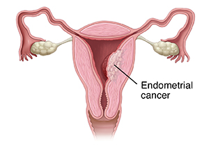 Front view cross section of female reproductive tract showing cancer in uterus.