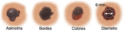 Lunar con forma asimétrica. Lunar con bordes desiguales e indefinidos. Lunar con manchas claras y oscuras. Lunar con un diámetro transversal de 6 mm.