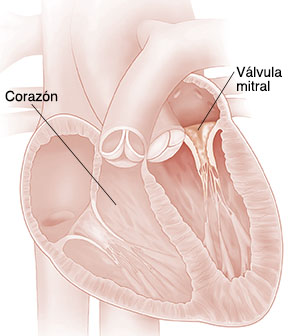 Corte transversal del corazón que muestra una válvula mitral con estenosis.