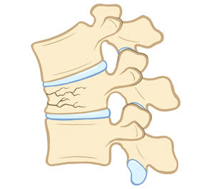 Side view of compression fracture flattening one spine vertebra.
