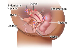 Endometrial implants can be found outside the endometrium, including the uterus, fallopian tubes, ovaries, bladder, and rectum.