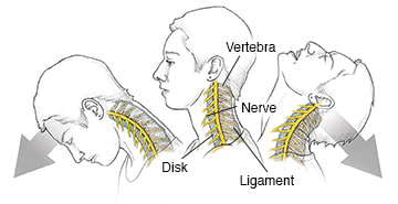 Side view of woman's head and neck showing neck vertebrae, ligaments, and nerves during whiplash: neutral position, in hyperflexion, and in hyperextension.