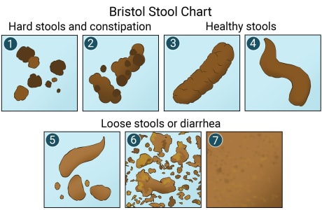 Bristol Stool Chart showing stool types, ranging from hard stools or constipation (types 1 and 2), to healthy stools (types 3 and 4), to loose stools or diarrhea (types 5,6,7).
