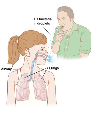 Man coughing, girl breathing TB bacteria in droplets into lungs.