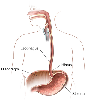 Outline of person showing mouth, esophagus, diaphragm, stomach, and hiatus.