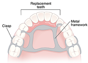 Roof of mouth and teeth showing the metal framework, replacement teeth, and clasp of partial denture.