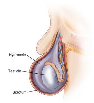 Male genital area, showing hydrocele formed around testicle in scrotum.