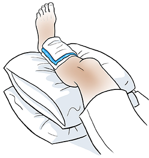 Leg elevated on pillows with ice pack wrapped in thin towel on ankle.