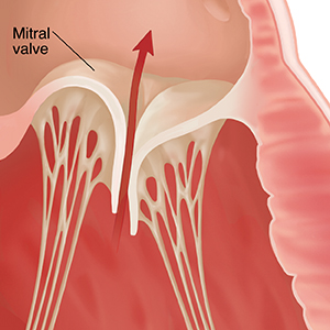 Close-up of mitral valve unable to close completely. Arrow shows blood leaking backwards through valve.