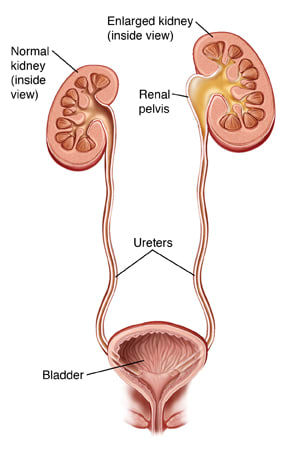 Kidneys, ureters, and bladder, showing normal kidney and enlarged kidney with ureter closed off near kidney and urine backing up into kidney.