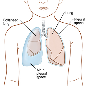 Outline of child showing lungs in chest, with left lung normal and surrounded by thin pleural space and right lung collapsed by air in pleural space.