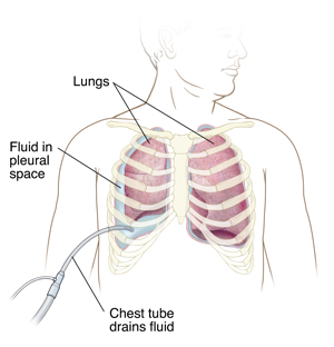 Man's chest showing tube draining fluid from space next to lung.