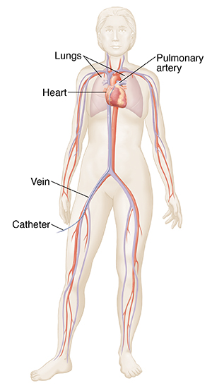 Front view of female outline showing heart, lungs, major arteries and veins. Catheter inserted in femoral vein going to heart.