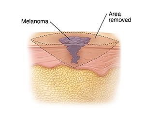 Skin layers with melanoma, showing incision lines to remove tumor.