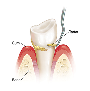 Side view of tooth in bone with instrument doing scaling to remove tartar.