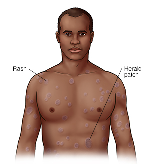 Front view of head and chest showing pityriasis rosea.