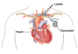 Outline of man's chest showing biventricular pacemaker ICD in chest with three leads going into heart chambers.