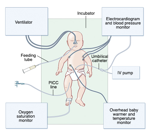 Baby in incubator showing neonatal intensive care unit equipment.