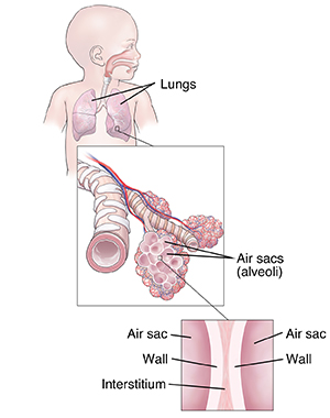 Front view of infant showing respiratory system with closeup of alveoli and interstitial tissue.