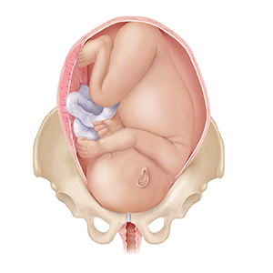 Front view of full-term fetus in uterus between pelvic bones, with head down. Head and body are too large for birth canal.