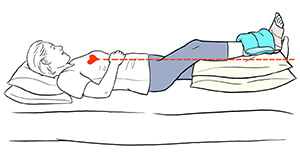 Person lying down with one leg elevated above level of heart. Bandage and ice pack are on ankle.