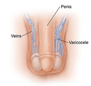 Male genitals, with labels for veins, varicocele above left testicle, and penis.