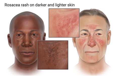 Rosacea rash on face, showing purplish on darker skin and reddish on lighter skin.