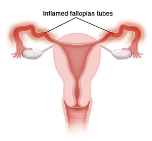 Cross section front view of vagina, uterus, fallopian tubes, and ovaries. Fallopian tubes are inflamed.