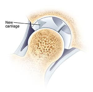 Hip joint with femoral head moved out of socket, showing new cartilage that formed over area where small holes were placed.