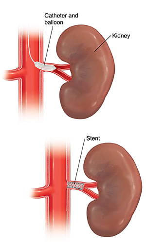 Kidney with balloon catheter in renal artery and kidney with stent in renal artery.