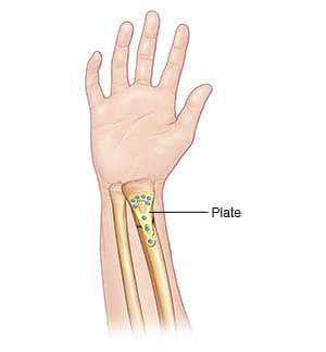 Forearm with a plate holding fractured radius in place.