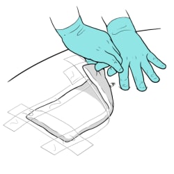 Gloved hands pulling back dressing from one corner toward incision.