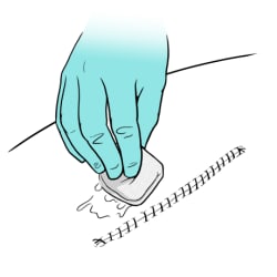 Gloved hand folding gauze and dabbing around incision.