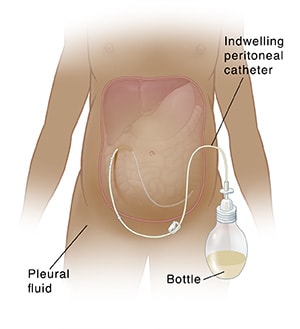 Anterior view of female torso with extended abdomen showing catheter attached to drainage bottle and inserted under skin and into peritoneum.