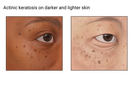 Actinic keratosis on the eyelid and the skin around the eyes, showing the condition on darker and lighter skin.