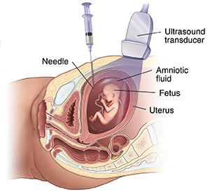 Cross section of pelvic area showing uterus, fetus, ultrasound probe, and needle taking sample of amniotic fluid.