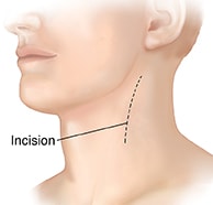 Three-quarter view of head and neck showing incision on neck for endarterectomy.