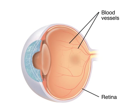 Cross section three-quarter view of eye showing normal blood vessels on retina.