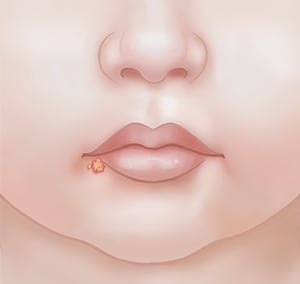 Closeup of mouth showing blister on lower lip.