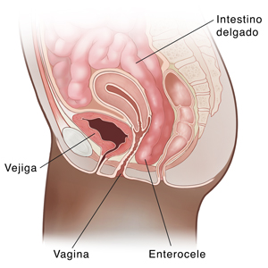 Seccion transversal de vista lateral de la pelvis femenina en la que se muestra el intestino delgado prolapsado (enterocele).