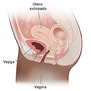 Seccionamiento transversal de la pelvis femenina con vista lateral que muestra una histerectomía.