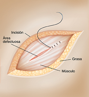 Piel con una incisión abierta que muestra un defecto en el músculo que se está suturando con una aguja quirúrgica.