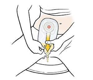 Una mujer sentada en el inodoro vaciando la bolsa de urostomía en el inodoro. 