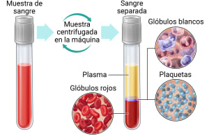 Se toma una muestra de sangre y se hace girar en una máquina para separar la sangre en plasma, glóbulos blancos, plaquetas y glóbulos rojos.
