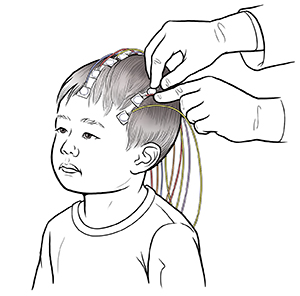 Hands of health care provider attaching EEG discs on young child's head, with discs connected to wires.