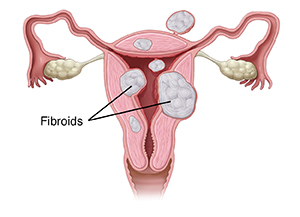 Front view cross section of uterus showing three types of fibroids.
