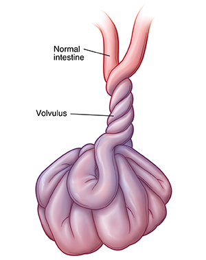 Front view of intestine twisted around itself (volvulus).