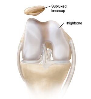 Front view of bent knee showing dislocated kneecap.