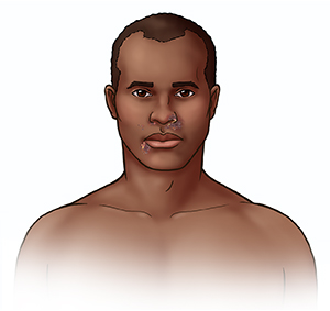 Front view of adult's face showing impetigo around nose and mouth.