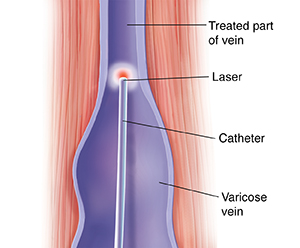 Cross section of muscle and varicose vein showing laser treatment using catheter.